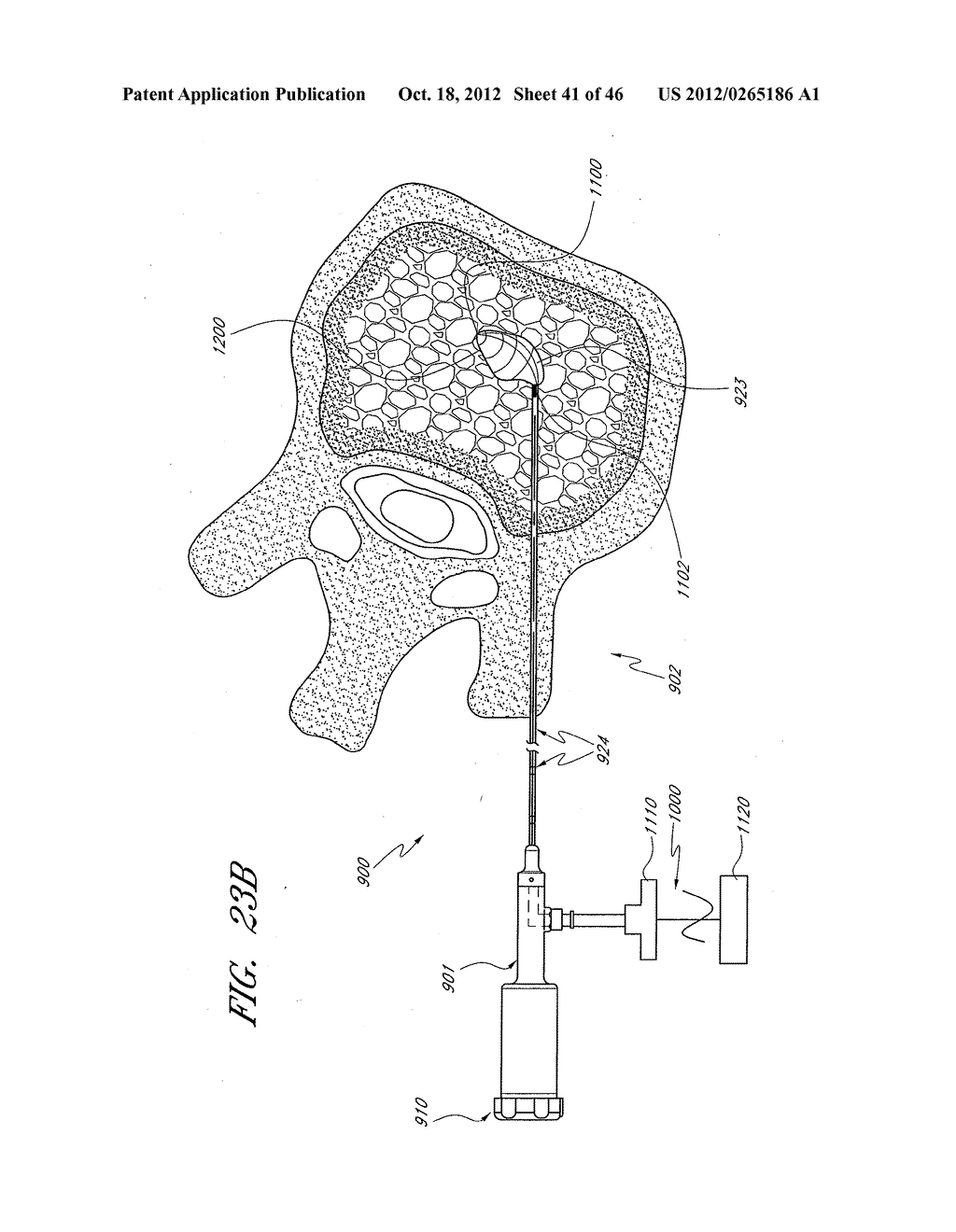 STEERABLE CURVABLE ABLATION CATHETER FOR VERTEBROPLASTY - diagram, schematic, and image 42