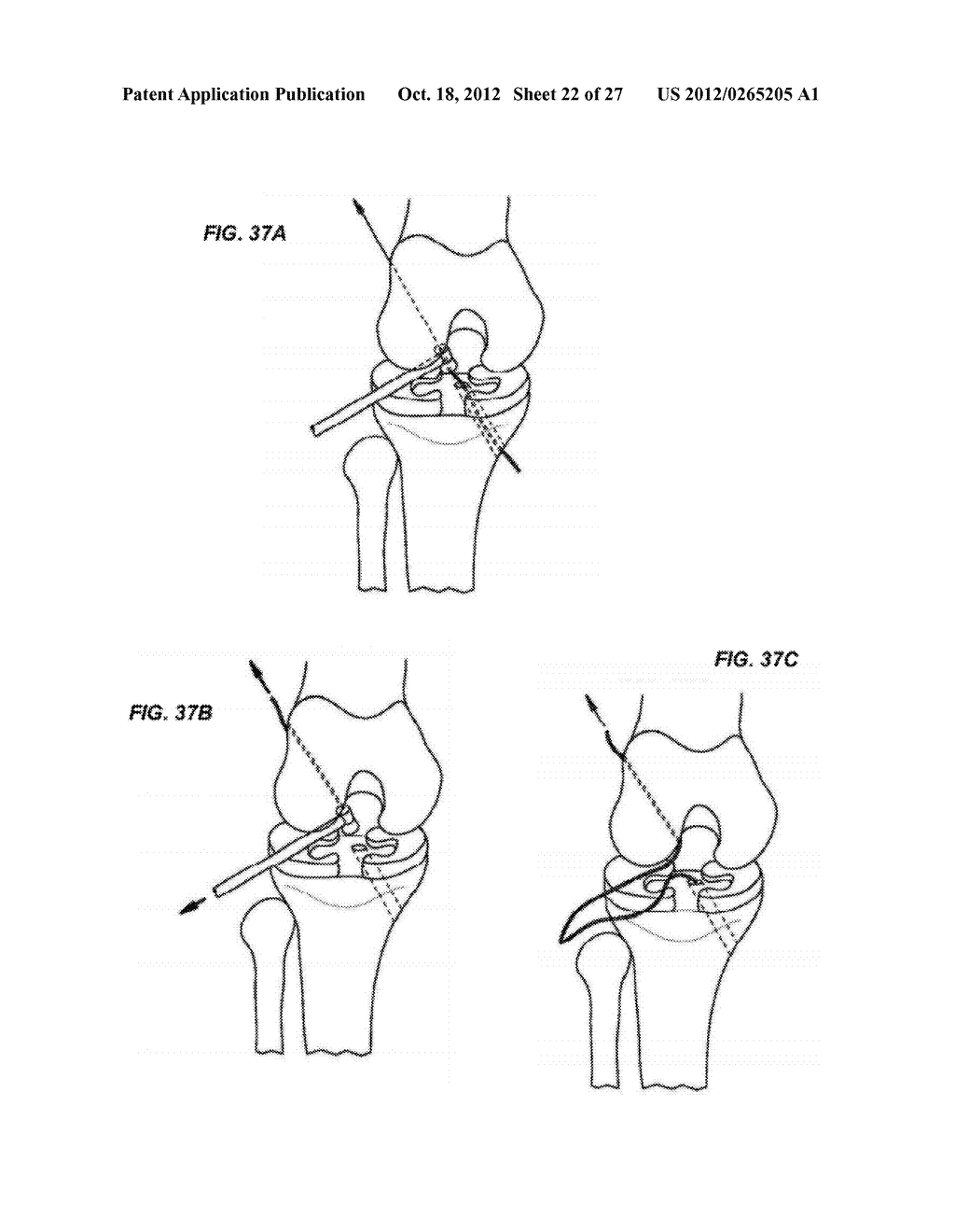 FLEXIBLE ACL INSTRUMENTATION, KIT AND METHOD - diagram, schematic, and image 23