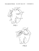 ARTHROSCOPIC TECHNIQUE FOR LOAD SHARING WITH PATCH AND SUTURE ASSEMBLY diagram and image