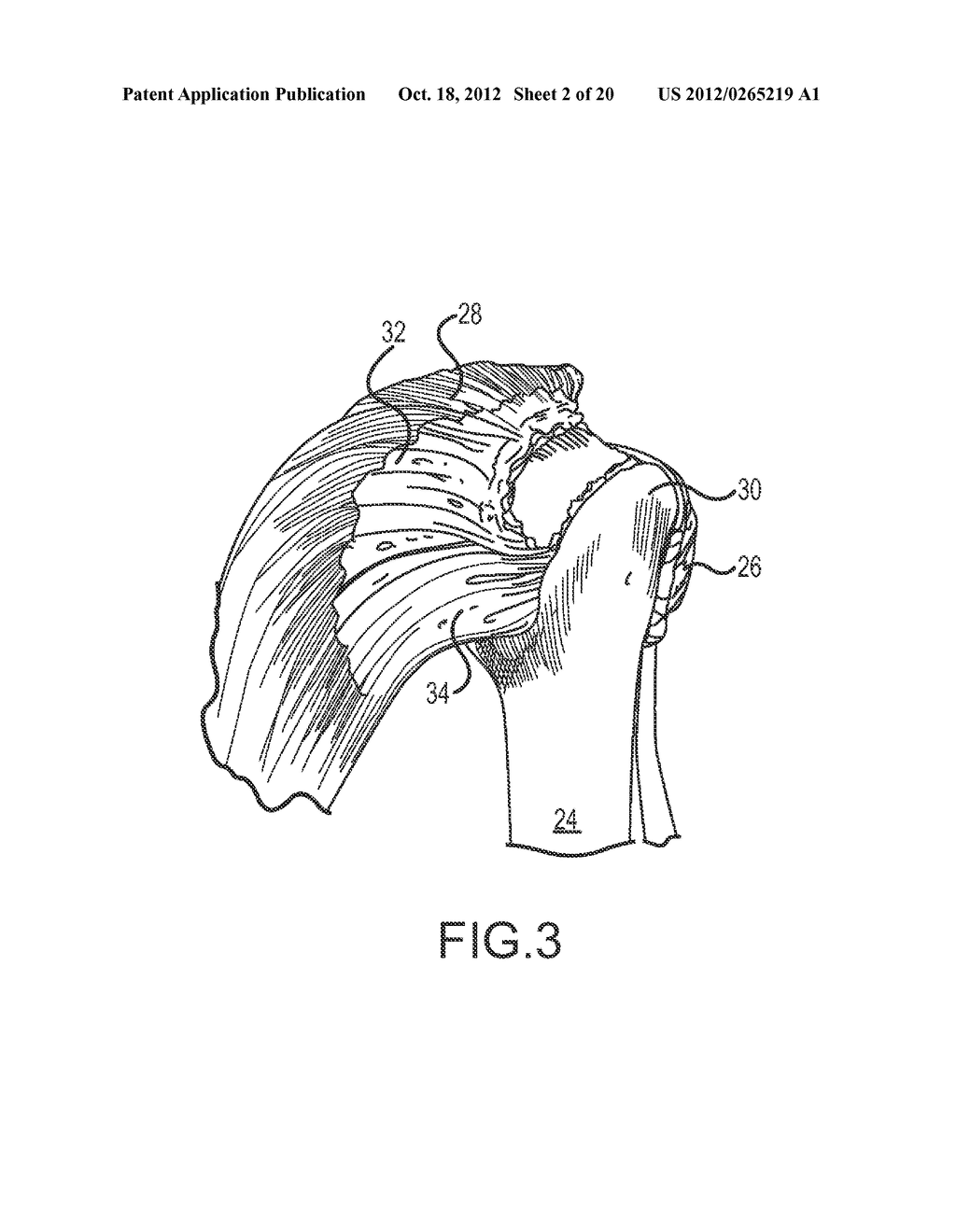 ARTHROSCOPIC TECHNIQUE FOR LOAD SHARING WITH PATCH AND SUTURE ASSEMBLY - diagram, schematic, and image 03