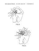 ARTHROSCOPIC TECHNIQUE FOR LOAD SHARING WITH PATCH AND SUTURE ASSEMBLY diagram and image