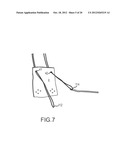 ARTHROSCOPIC TECHNIQUE FOR LOAD SHARING WITH PATCH AND SUTURE ASSEMBLY diagram and image