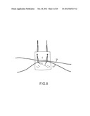 ARTHROSCOPIC TECHNIQUE FOR LOAD SHARING WITH PATCH AND SUTURE ASSEMBLY diagram and image