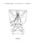 ARTHROSCOPIC TECHNIQUE FOR LOAD SHARING WITH PATCH AND SUTURE ASSEMBLY diagram and image