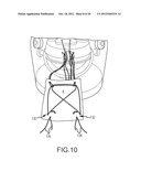 ARTHROSCOPIC TECHNIQUE FOR LOAD SHARING WITH PATCH AND SUTURE ASSEMBLY diagram and image