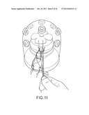 ARTHROSCOPIC TECHNIQUE FOR LOAD SHARING WITH PATCH AND SUTURE ASSEMBLY diagram and image