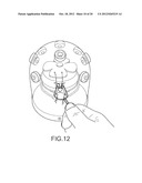 ARTHROSCOPIC TECHNIQUE FOR LOAD SHARING WITH PATCH AND SUTURE ASSEMBLY diagram and image