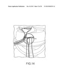 ARTHROSCOPIC TECHNIQUE FOR LOAD SHARING WITH PATCH AND SUTURE ASSEMBLY diagram and image