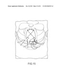 ARTHROSCOPIC TECHNIQUE FOR LOAD SHARING WITH PATCH AND SUTURE ASSEMBLY diagram and image