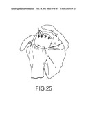 ARTHROSCOPIC TECHNIQUE FOR LOAD SHARING WITH PATCH AND SUTURE ASSEMBLY diagram and image