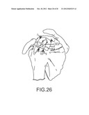 ARTHROSCOPIC TECHNIQUE FOR LOAD SHARING WITH PATCH AND SUTURE ASSEMBLY diagram and image