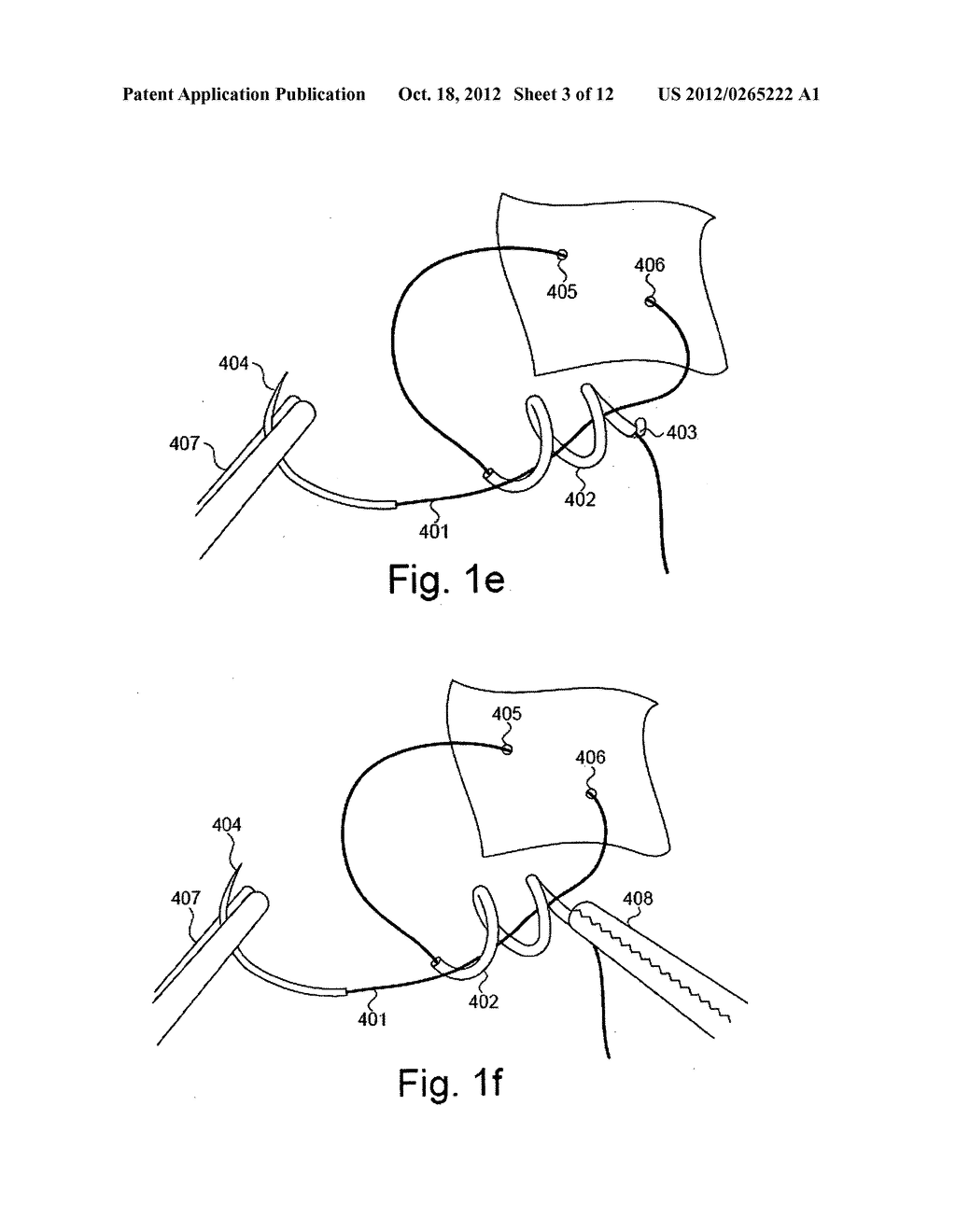 SYSTEM AND METHOD FOR FORMING A KNOT - diagram, schematic, and image 04