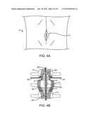 DEVICE AND ACCESSORIES FOR LIMITING FLEXION diagram and image