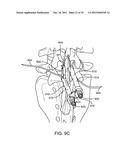 DEVICE AND ACCESSORIES FOR LIMITING FLEXION diagram and image