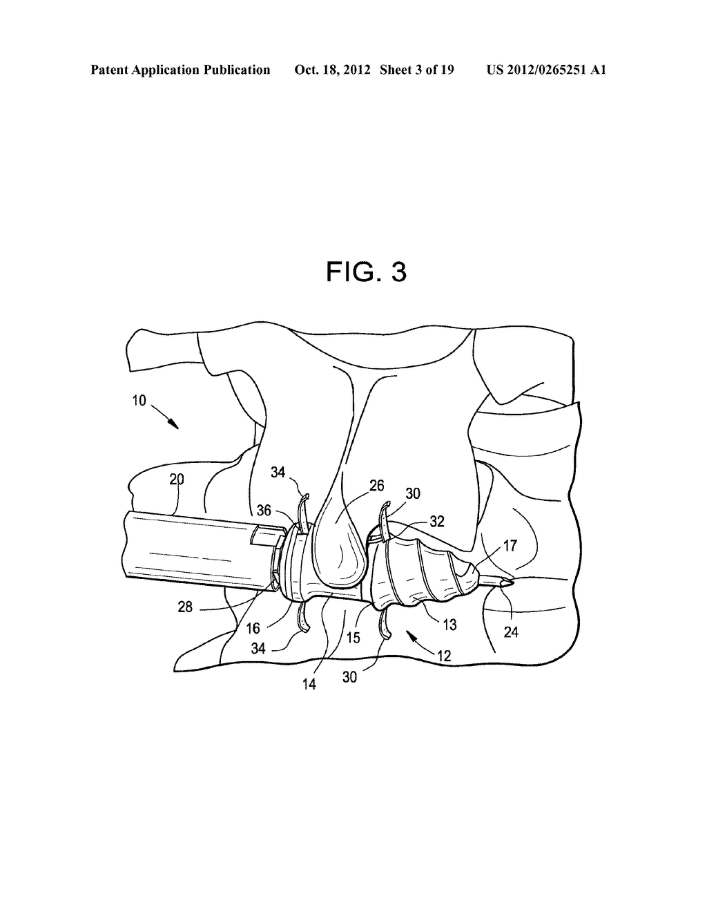 CONICAL INTERSPINOUS APPARATUS AND A METHOD OF PERFORMING INTERSPINOUS     DISTRACTION - diagram, schematic, and image 04