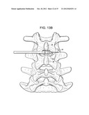 CONICAL INTERSPINOUS APPARATUS AND A METHOD OF PERFORMING INTERSPINOUS     DISTRACTION diagram and image