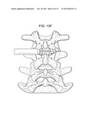 CONICAL INTERSPINOUS APPARATUS AND A METHOD OF PERFORMING INTERSPINOUS     DISTRACTION diagram and image