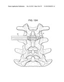 CONICAL INTERSPINOUS APPARATUS AND A METHOD OF PERFORMING INTERSPINOUS     DISTRACTION diagram and image