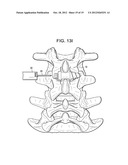 CONICAL INTERSPINOUS APPARATUS AND A METHOD OF PERFORMING INTERSPINOUS     DISTRACTION diagram and image