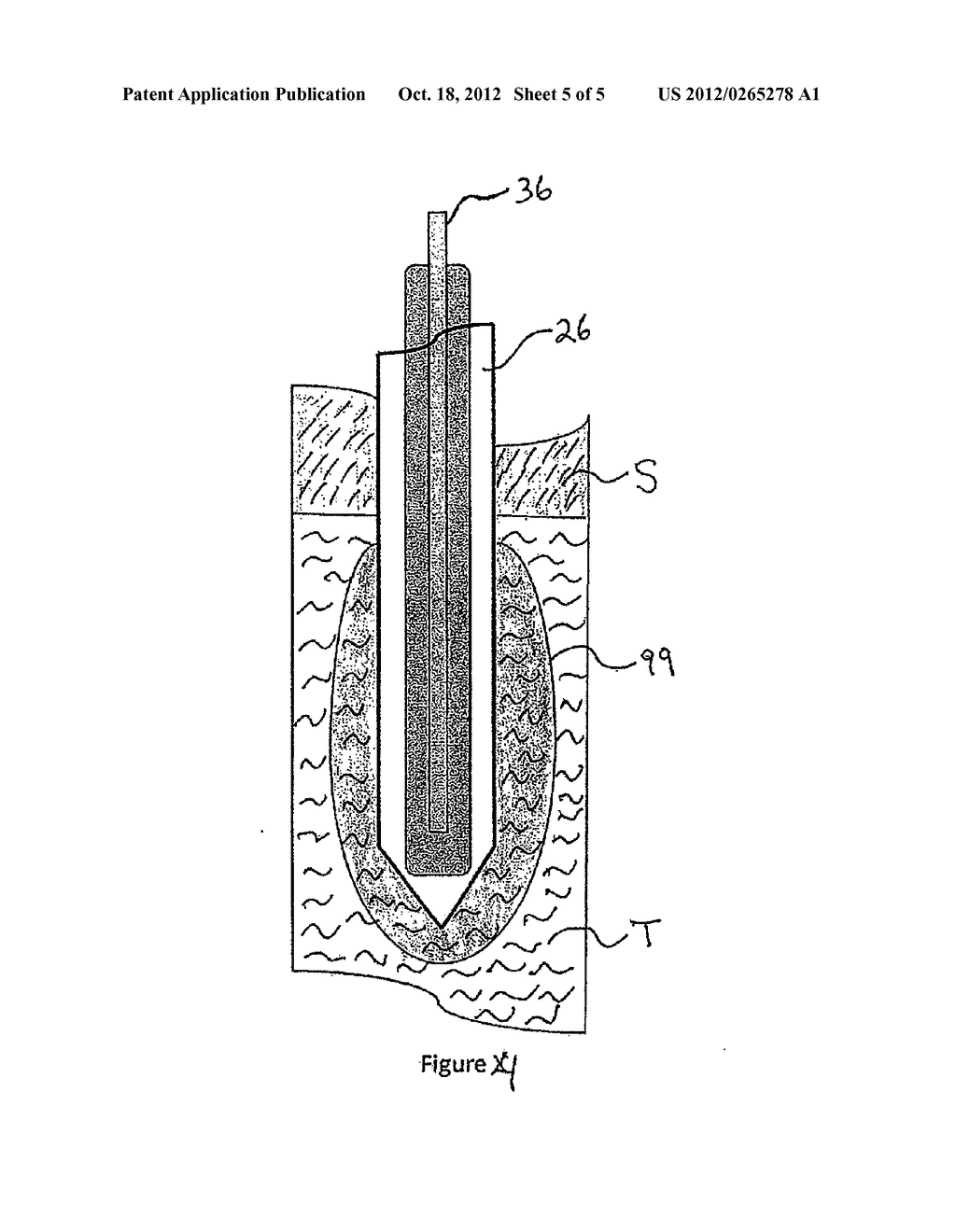 INTEGRATED CRYOSURGICAL SYSTEM WITH REFRIGERANT AND ELECTRICAL POWER     SOURCE - diagram, schematic, and image 06