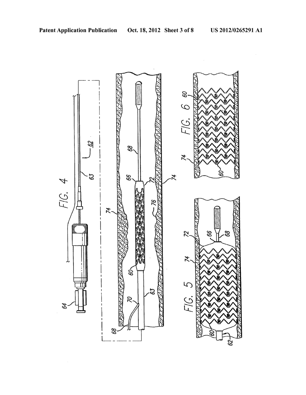 MANUFACTURE OF FINE-GRAINED MATERIAL FOR USE IN MEDICAL DEVICES - diagram, schematic, and image 04