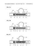 STENT SYSTEM HAVING INTERMESHING SIDE EXTENSION MEMBERS diagram and image