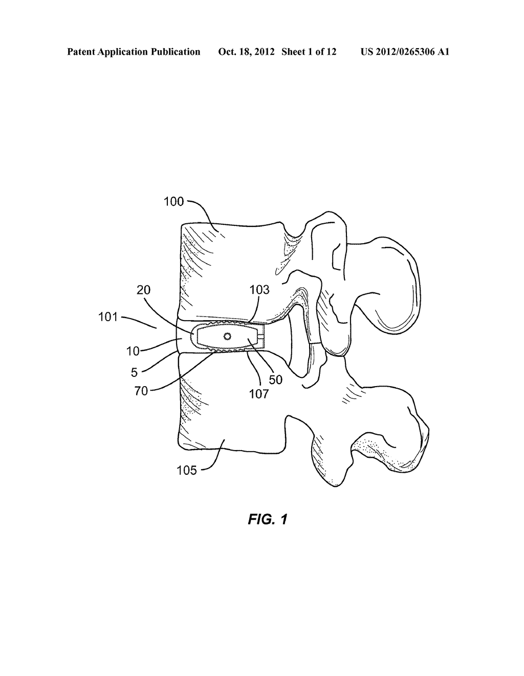 SPINAL IMPLANT WITH ATTACHABLE BONE SECURING COMPONET - diagram, schematic, and image 02