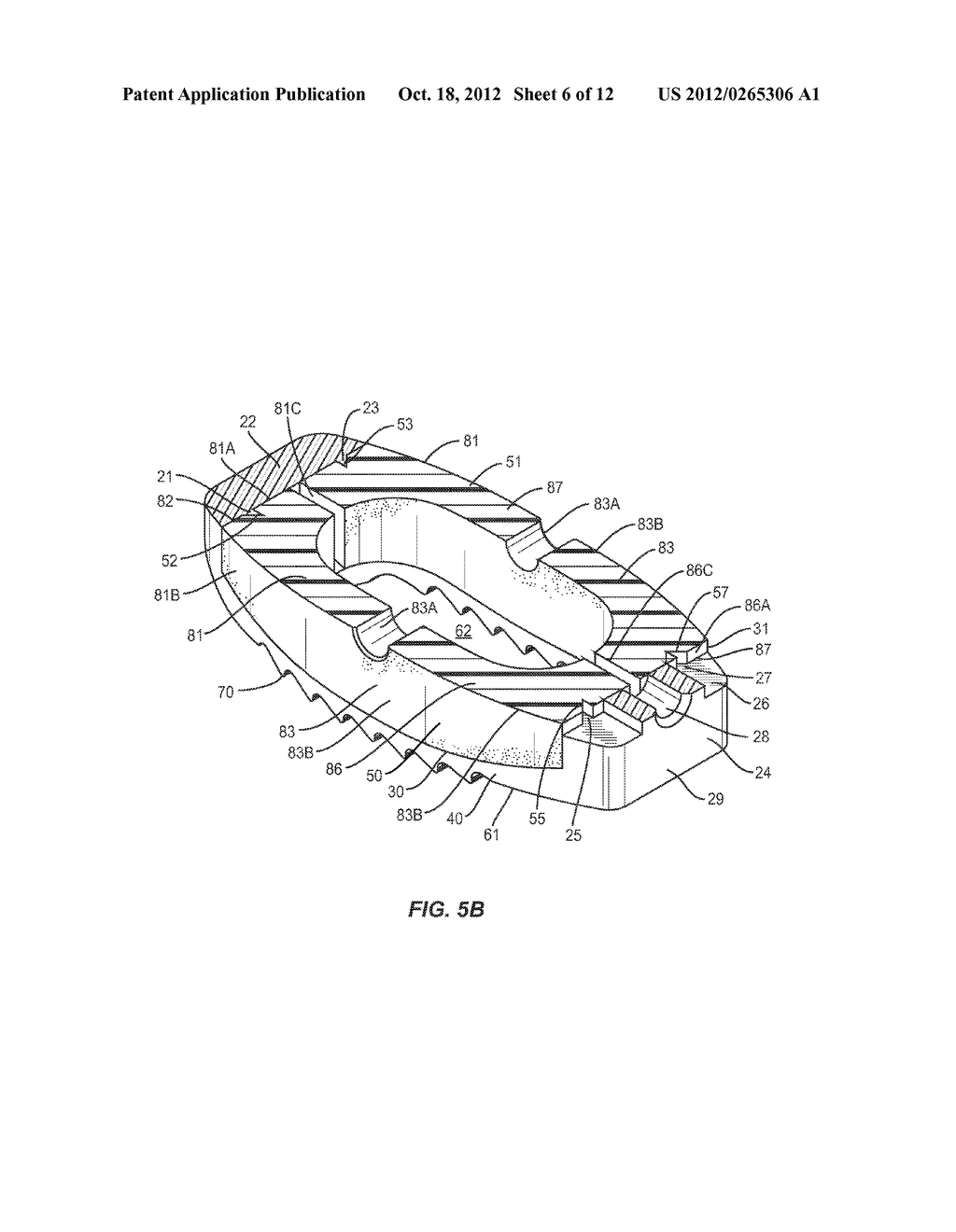 SPINAL IMPLANT WITH ATTACHABLE BONE SECURING COMPONET - diagram, schematic, and image 07