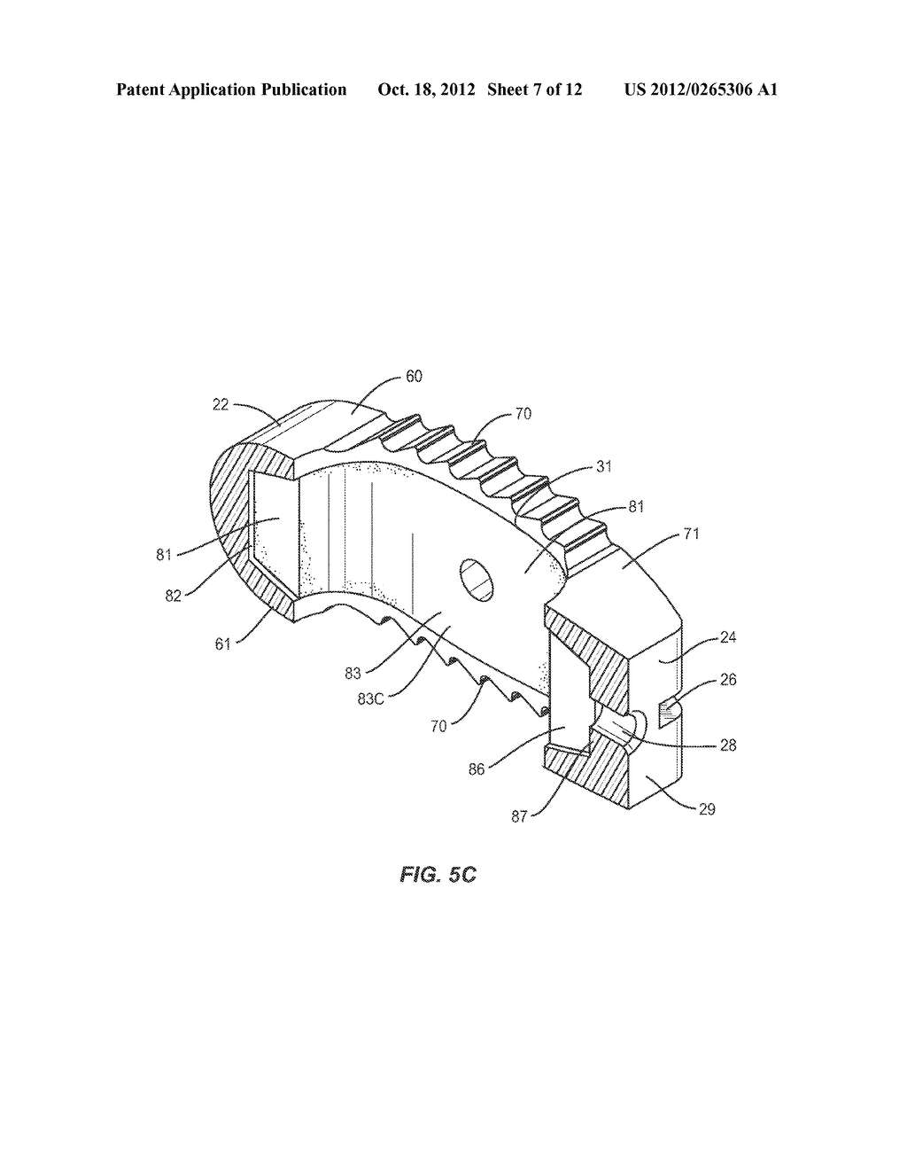 SPINAL IMPLANT WITH ATTACHABLE BONE SECURING COMPONET - diagram, schematic, and image 08