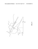 Medical Support Pillow for Facilitating Tracheal Intubation on Obese     Patient diagram and image