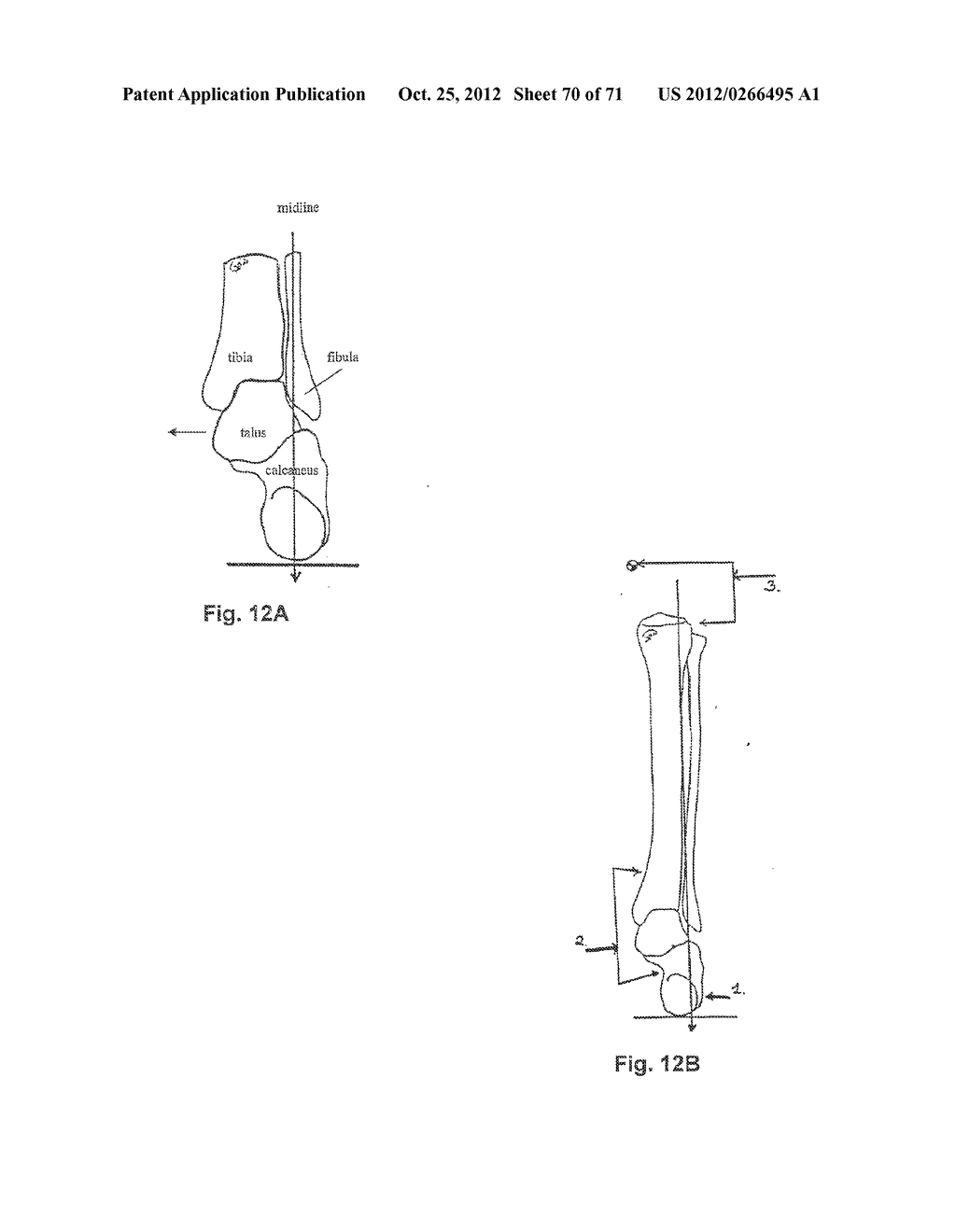 Support System for Footwear Providing Support at or Below the     Sustentaculum Tali - diagram, schematic, and image 71