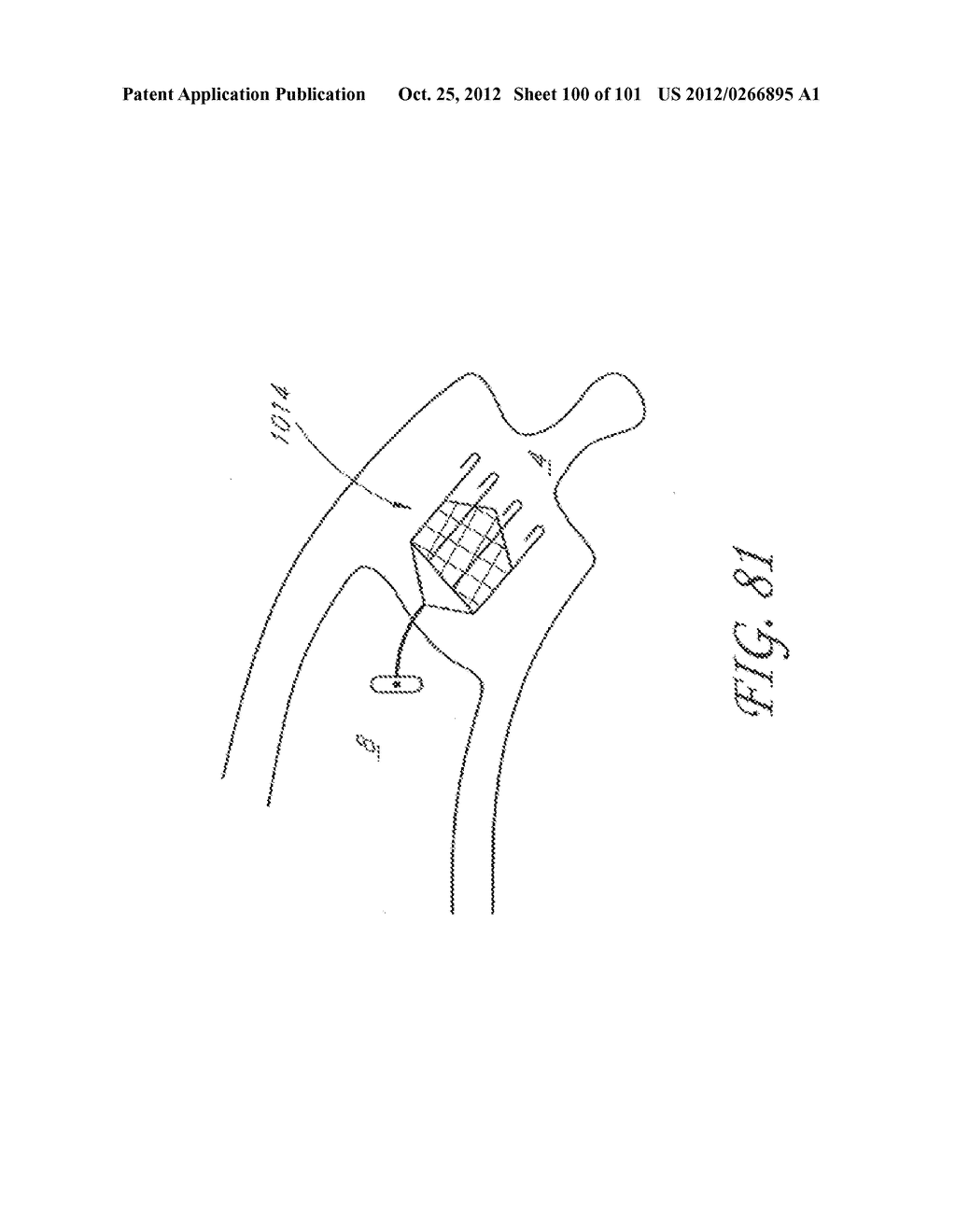 SYSTEM AND METHOD FOR PERCUTANEOUS PALATE REMODELING - diagram, schematic, and image 101