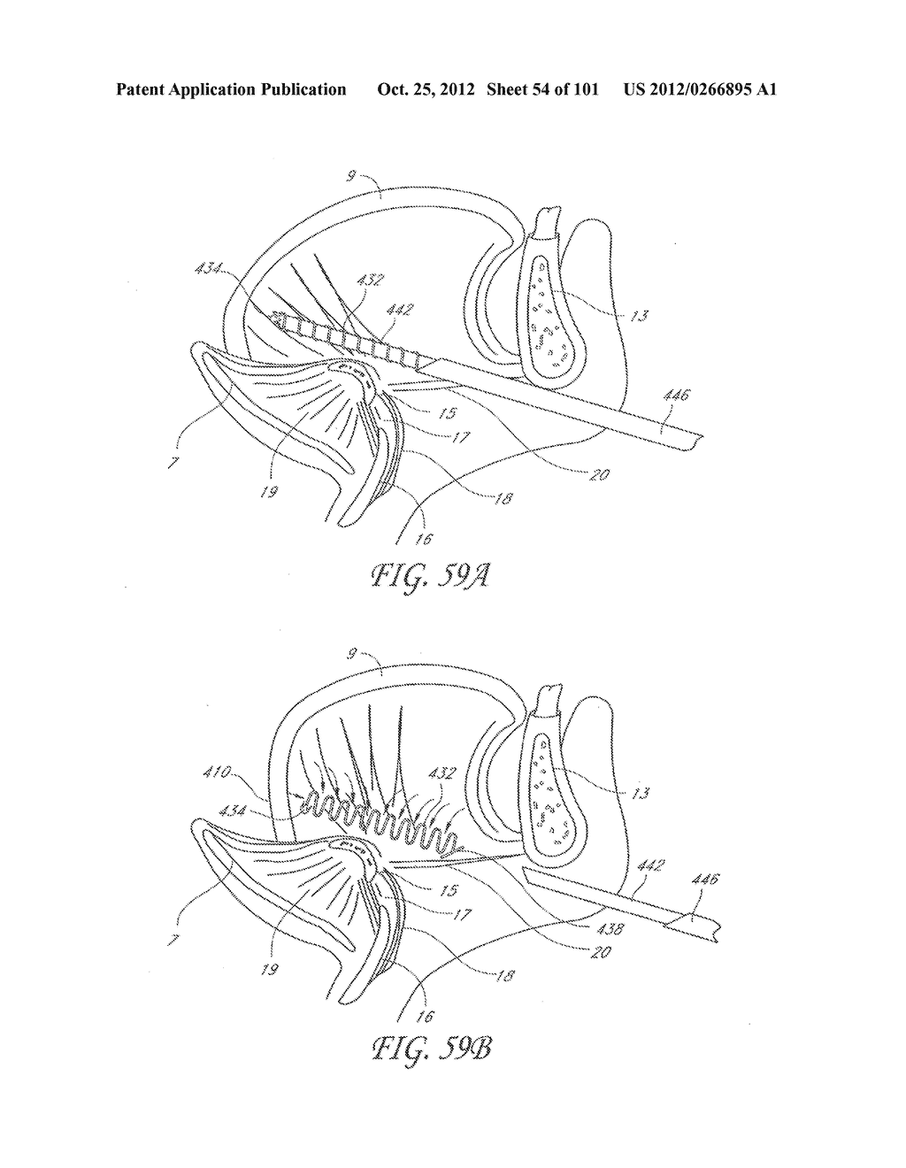 SYSTEM AND METHOD FOR PERCUTANEOUS PALATE REMODELING - diagram, schematic, and image 55
