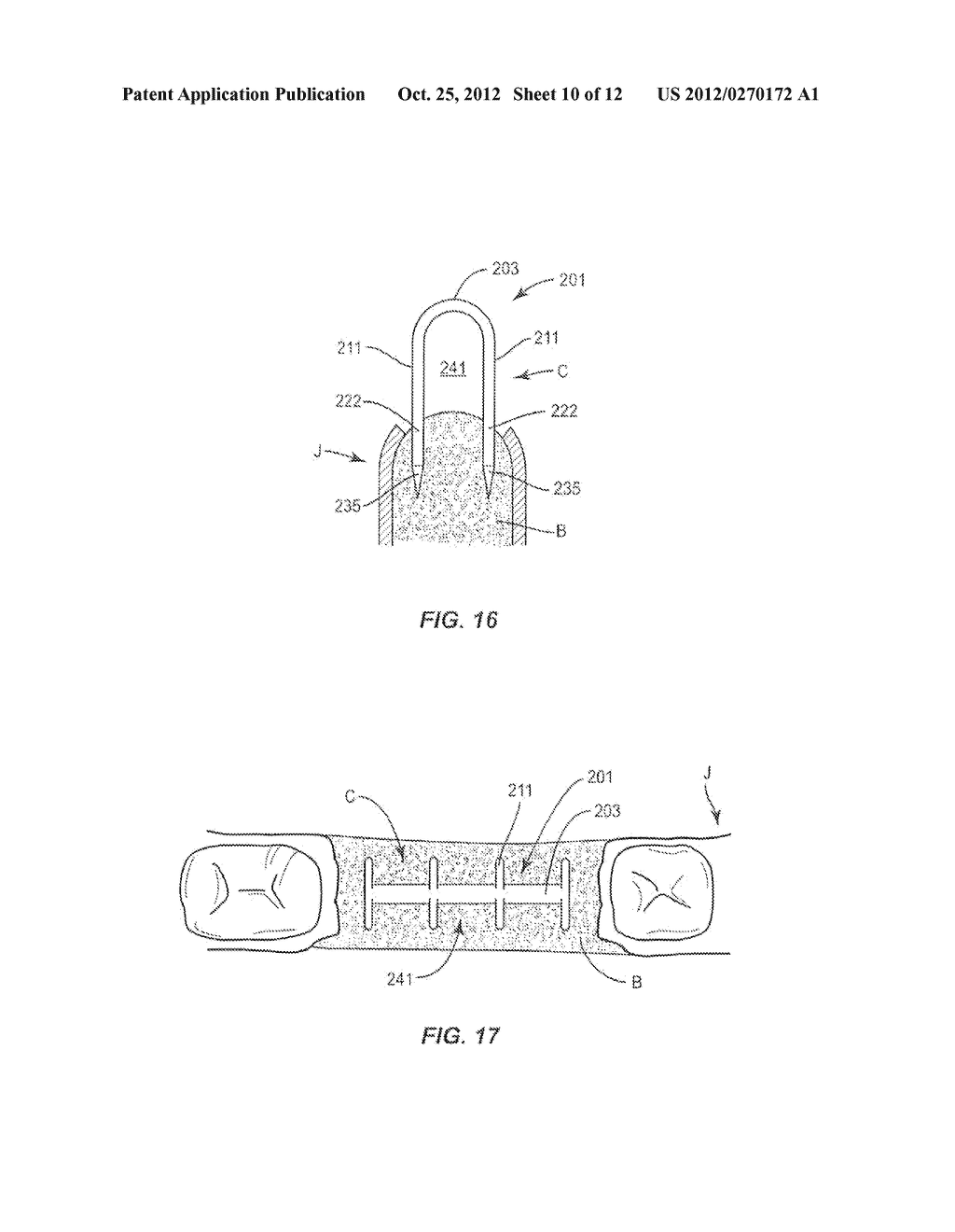 BONE AUGMENTATION DEVICE AND METHOD - diagram, schematic, and image 11