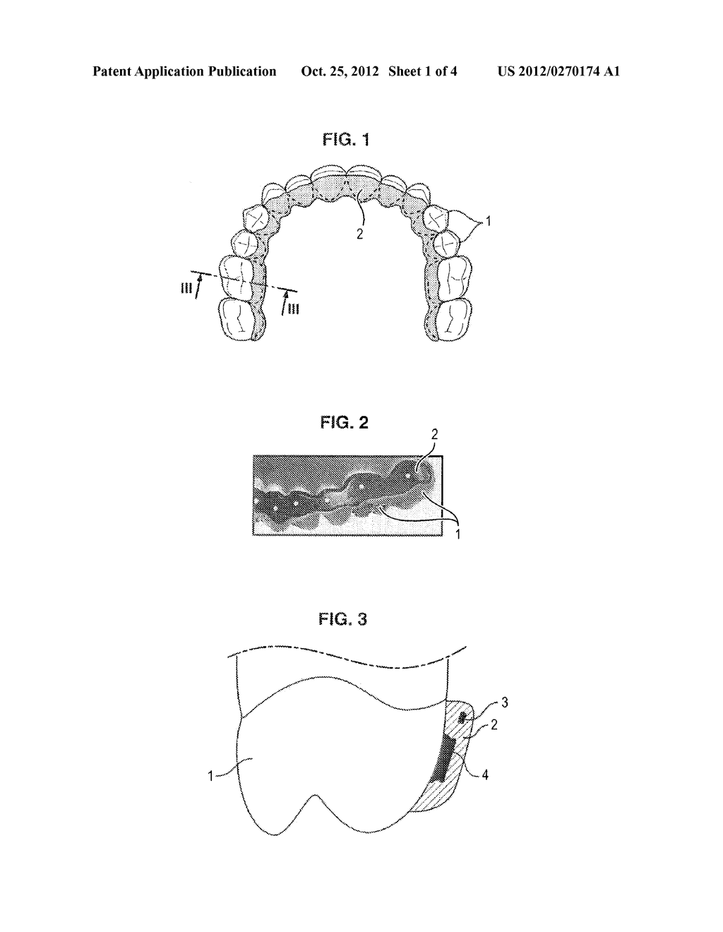 ORTHODONTIC WORKING ARCH WIRE, AND ORTHODONTIC TREATMENT SYSTEM INCLUDING     SAID ARCH WIRE - diagram, schematic, and image 02