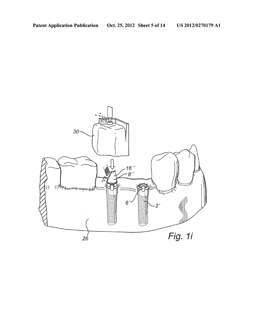 METHOD OF PROVIDING A PATIENT-SPECIFIC DENTAL FIXTURE-MATING ARRANGEMENT - diagram, schematic, and image 06