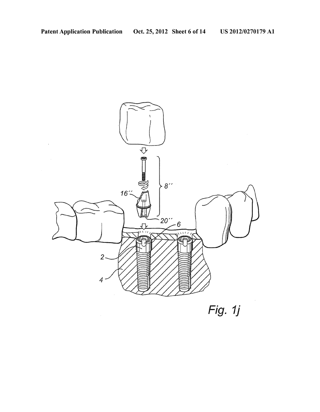 METHOD OF PROVIDING A PATIENT-SPECIFIC DENTAL FIXTURE-MATING ARRANGEMENT - diagram, schematic, and image 07