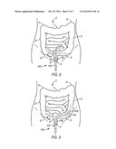 STEERABLE ENDOSCOPE AND IMPROVED METHOD OF INSERTION diagram and image