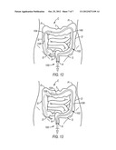 STEERABLE ENDOSCOPE AND IMPROVED METHOD OF INSERTION diagram and image