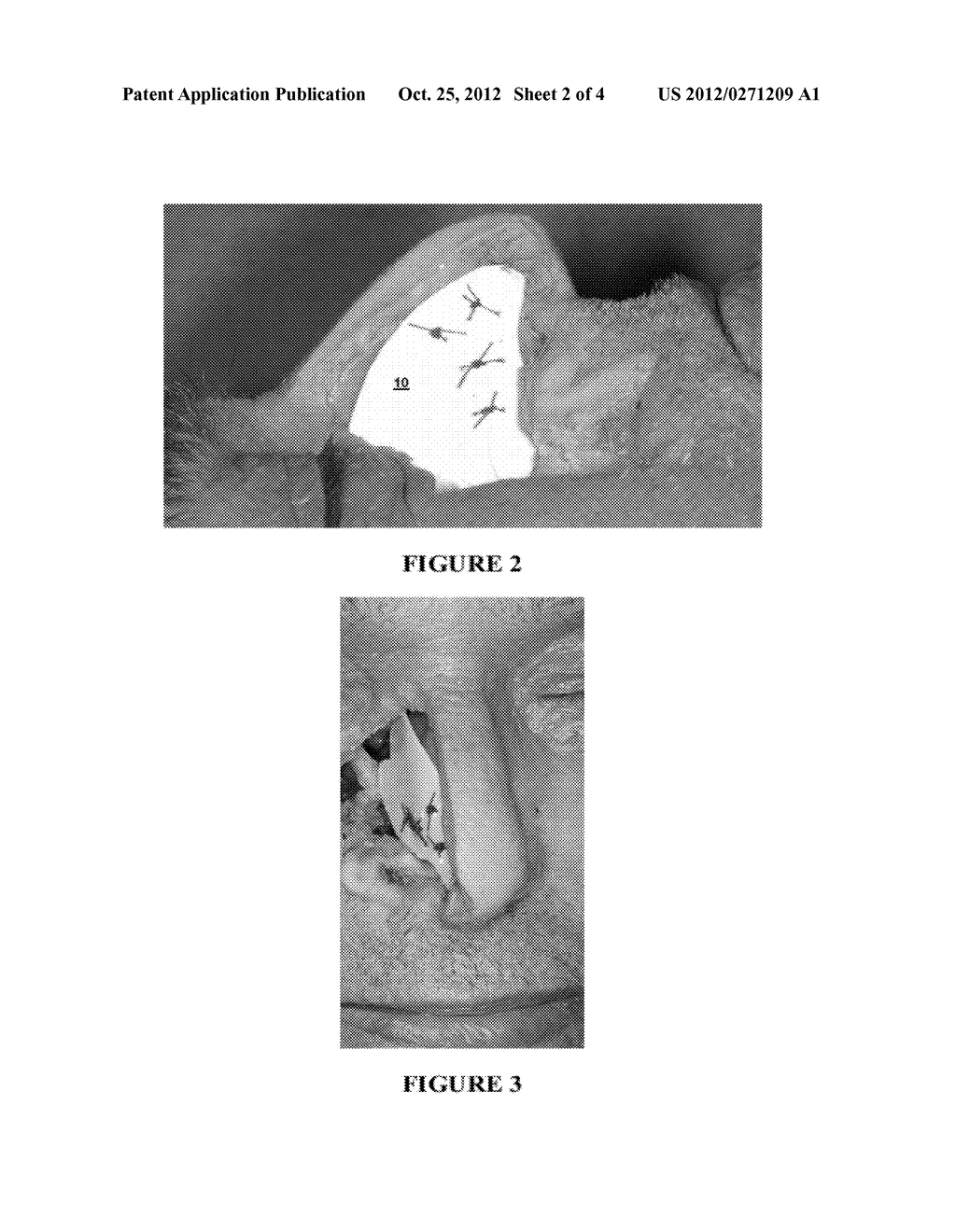 NASAL SEPTAL SPLINT AND METHODS FOR USING SAME - diagram, schematic, and image 03