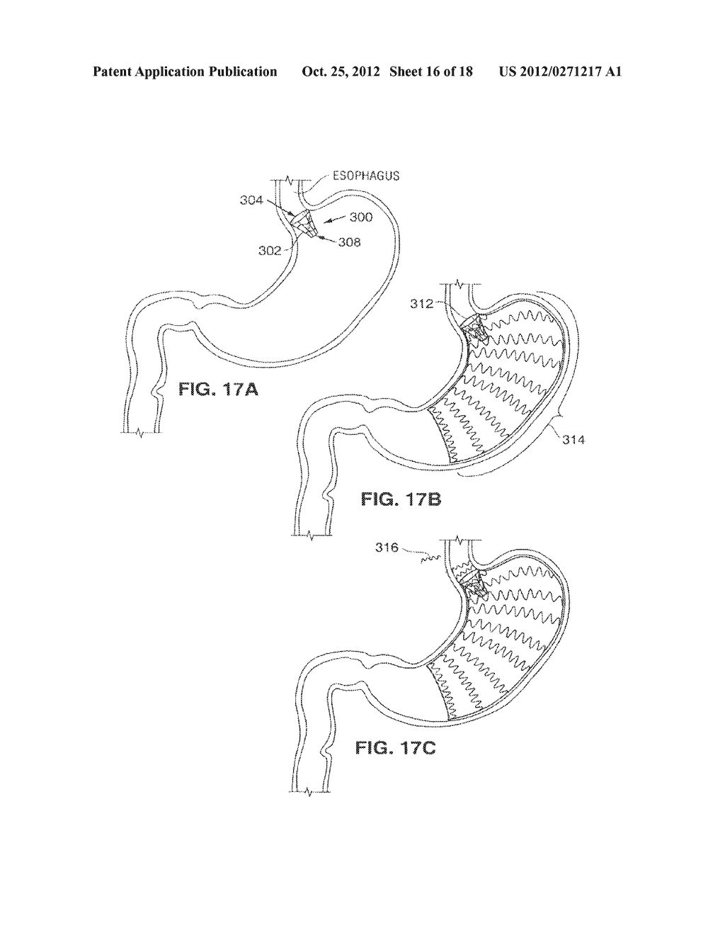 SATIATION DEVICES AND METHODS - diagram, schematic, and image 17