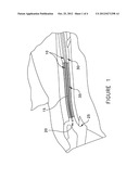 Method of Improved Vein Closure diagram and image