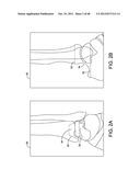 ORTHOPEDIC SURGICAL GUIDE diagram and image