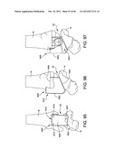 ORTHOPEDIC SURGICAL GUIDE diagram and image