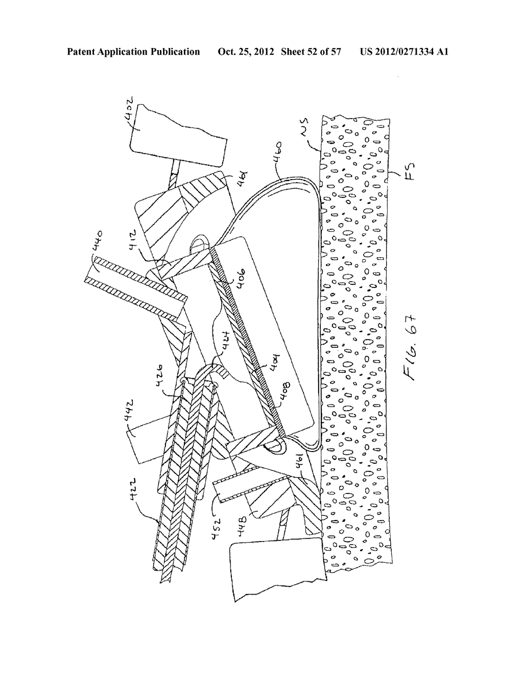 Apparatus and Method for Ablating Tissue - diagram, schematic, and image 53