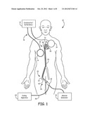 Method and Apparatus for Embolic Protection During Heart Procedure diagram and image