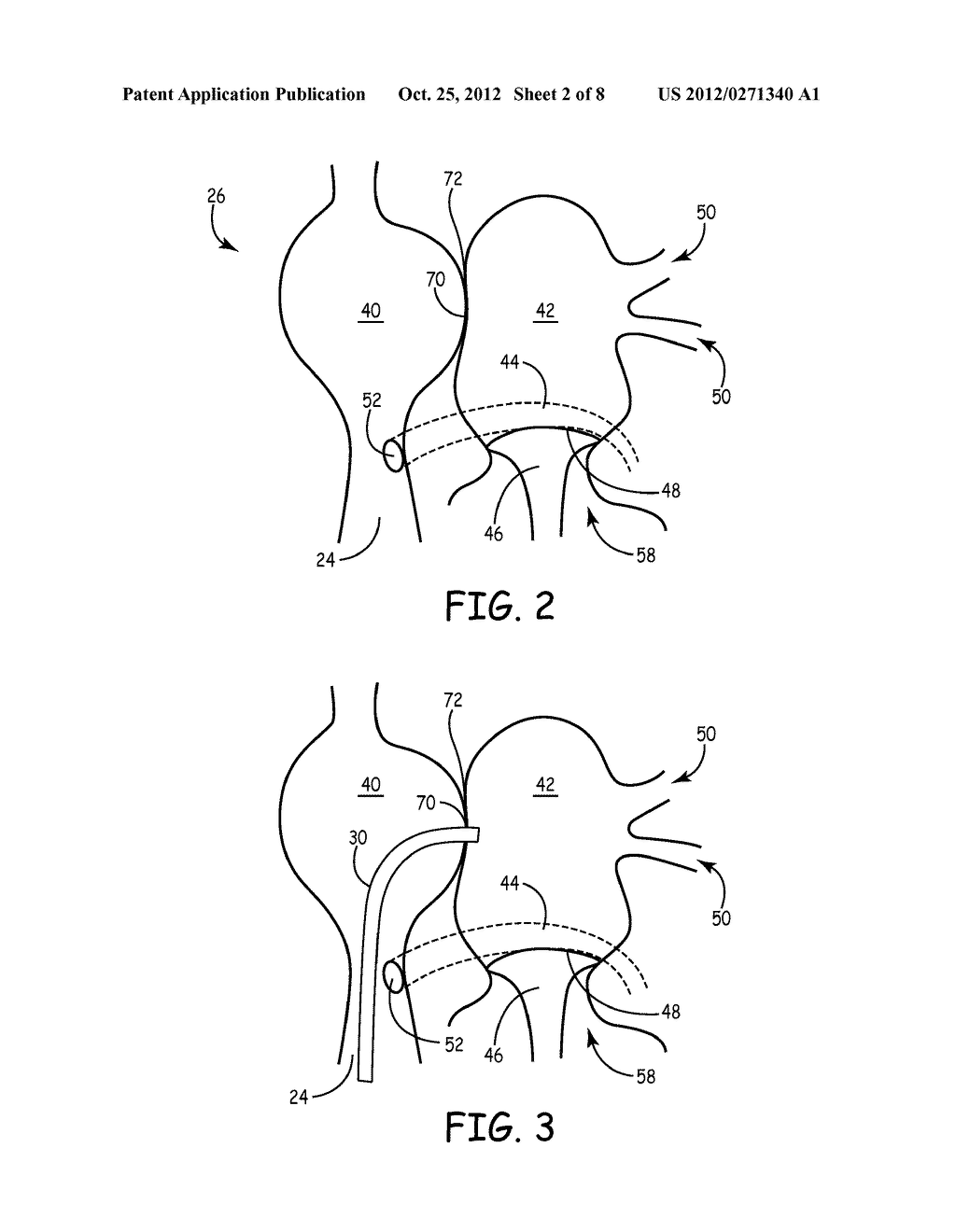 Method and Apparatus for Embolic Protection During Heart Procedure - diagram, schematic, and image 03