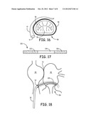 Method and Apparatus for Embolic Protection During Heart Procedure diagram and image