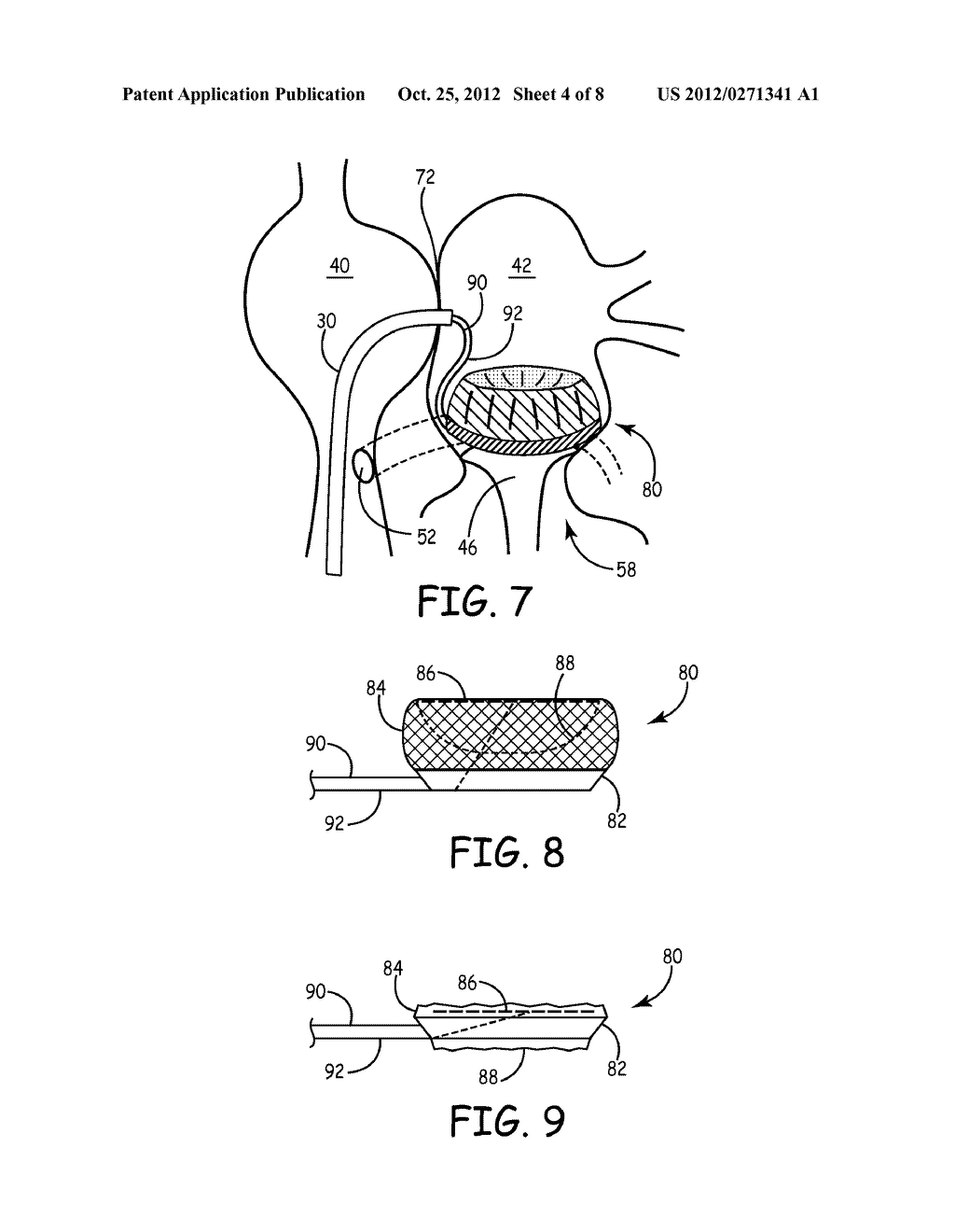 Method and Apparatus for Treating a Mitral Valve Prolapse and Providing     Embolic Protection - diagram, schematic, and image 05