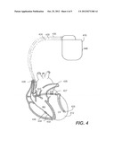 DEVICES, SYSTEMS AND METHODS FOR CHARACTERIZING A TACHYCARDIA AND/OR     SELECTING TREATMENT FOR A TACHYCARDIA USING RESULTS OF A FRACTIONATION     ANALYSIS diagram and image